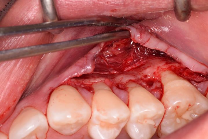 Que es la cirugia plastica periodontal