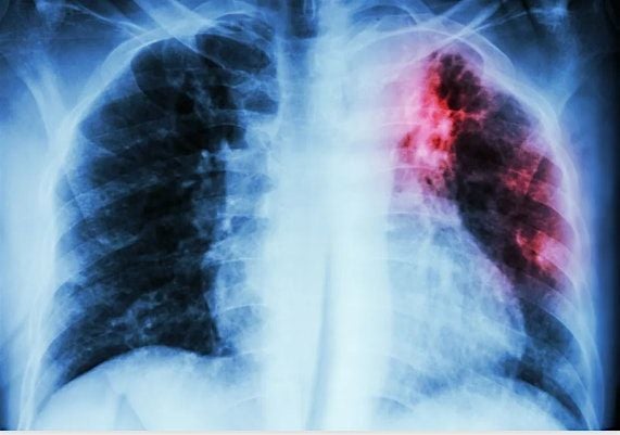 TB Skills Check-Off for Community Partners, 5 August | Event in Fort Wayne | AllEvents