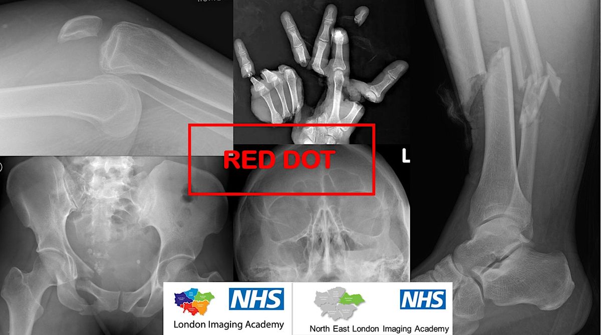 Online Red Dot at Lunch Series - Chest X-ray, 16 November 2023 ...