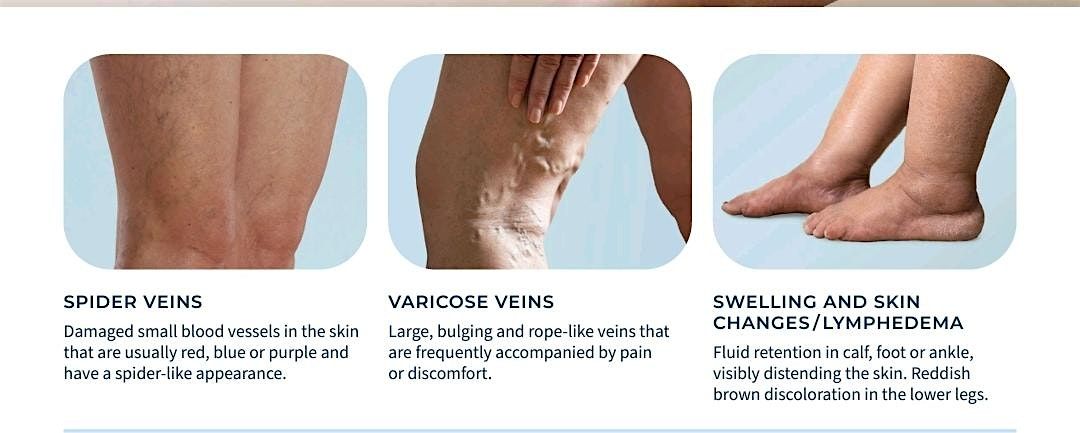 Vein Week at United Vein and Vascular, 27 May | Event in Kennesaw | AllEvents