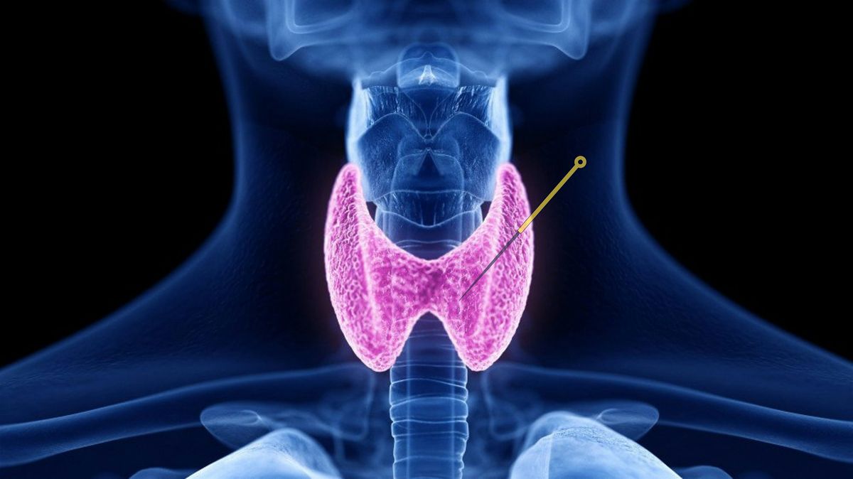 CEU - Acupuncture and Herbal Medicine Approaches to Thyroid Dysfunction, 27 July | Event in Berkeley | AllEvents
