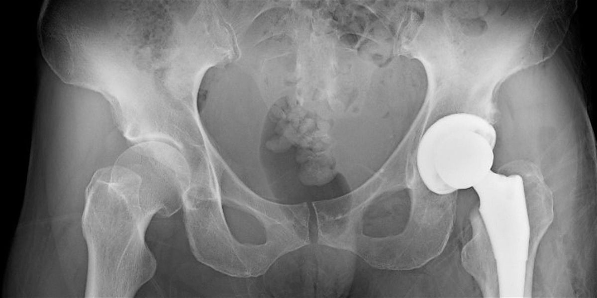 Harkness Saturday Series - Total Hip Replacement: Preparation & Recovery, 6 December | Event in New York