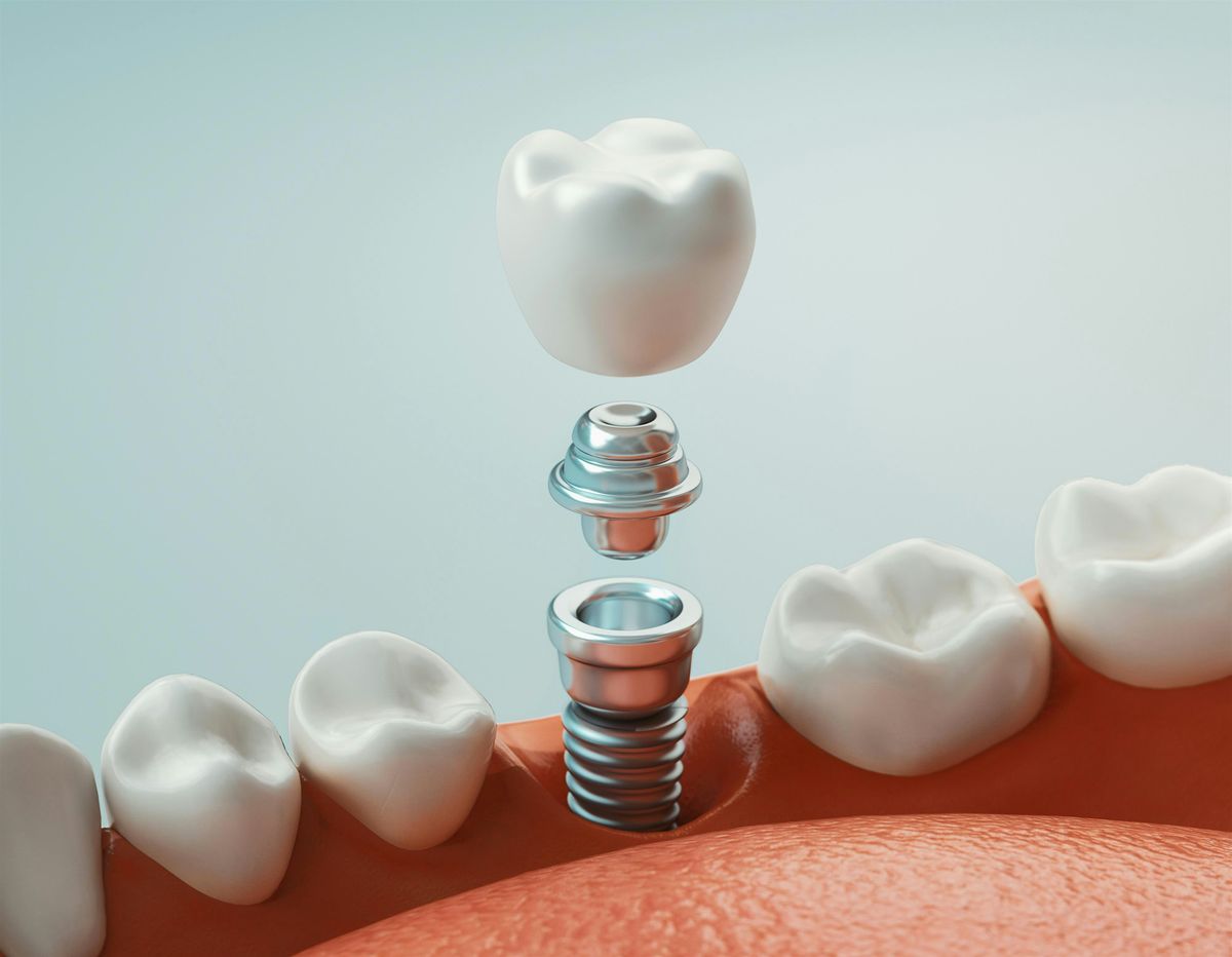 Mastering the Complexities of Implantology with Dr. Roxana Saldarriaga, 14 November | Event in Vancouver | AllEvents