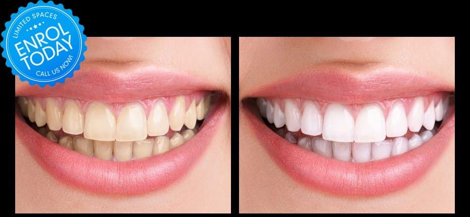Teeth Whitening Certification Make More Money Now Marietta Ga Or Online