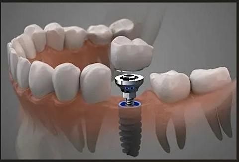 New Innovations In Immediate Site-Specific Implants, 22 October | Event in Chevy Chase | AllEvents