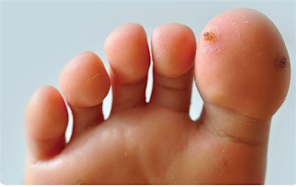 Verruca Needling - CPD, 16 May | Event in Bournemouth | AllEvents