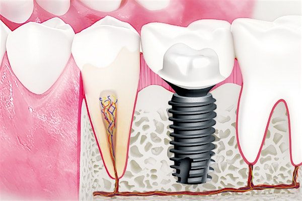 Advancing  Implant Techniques, 5 September | Event in Sandy | AllEvents