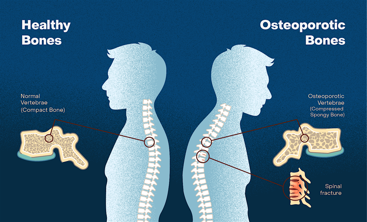 Osteoporosis Education Night, 10 September | Event in Ormeau | AllEvents