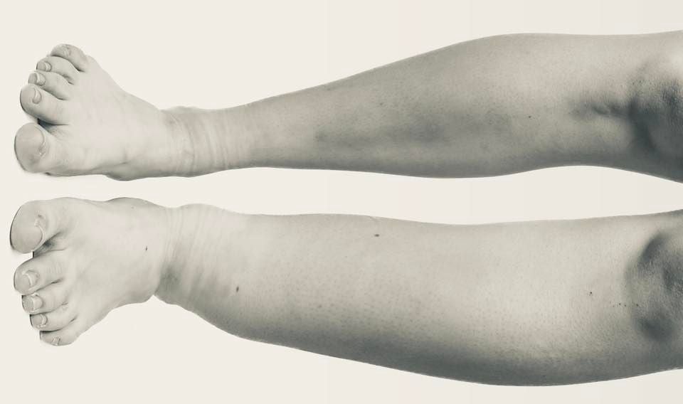 Lower Extremity Edema Management, Edmonton, Alberta, Canada, March 2 to